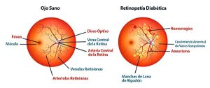 Imagen ojo diabético.