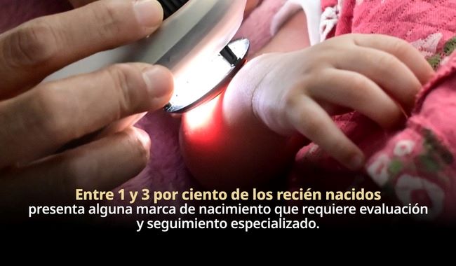 Marcas de nacimiento